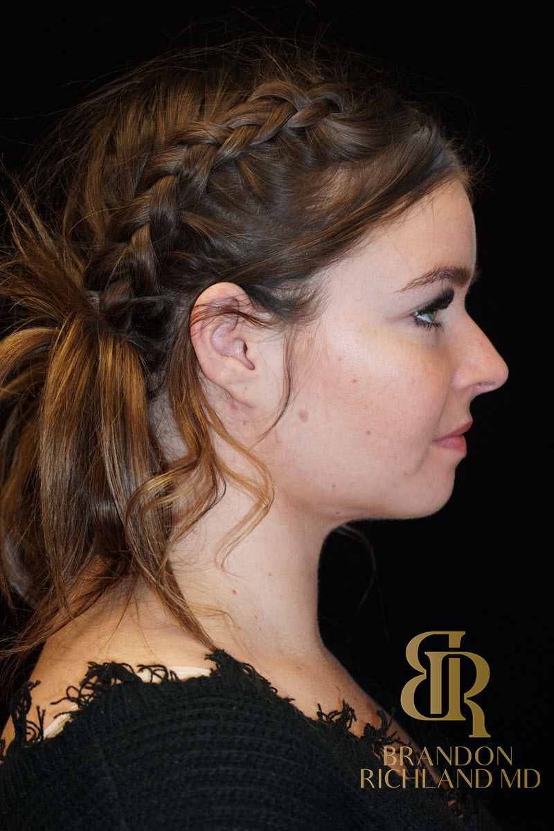 Chin Liposuction Before & After Image