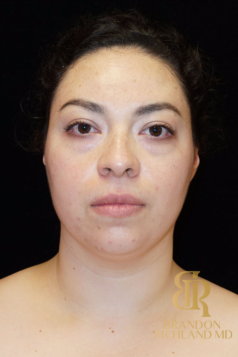 Chin Liposuction Before & After Image