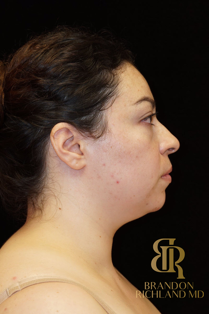 Chin Liposuction Before & After Image