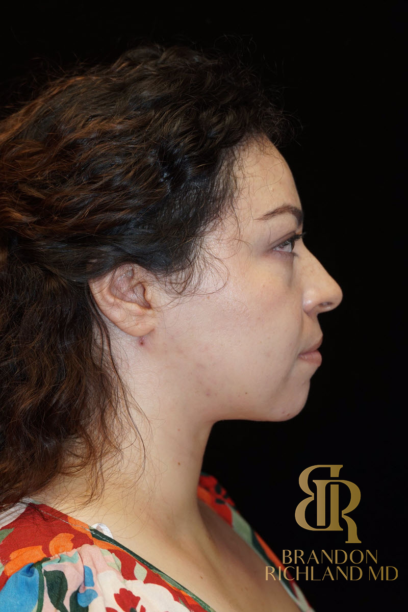 Chin Liposuction Before & After Image