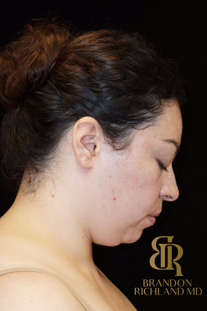 Chin Liposuction Before & After Image