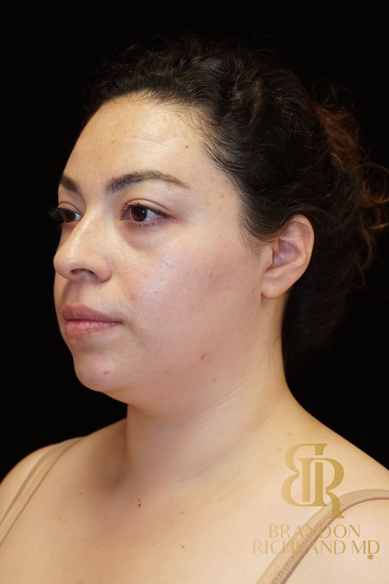 Chin Liposuction Before & After Image