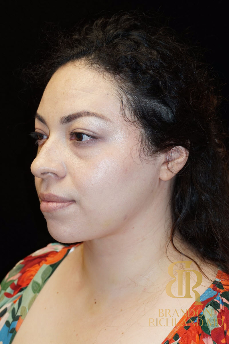 Chin Liposuction Before & After Image