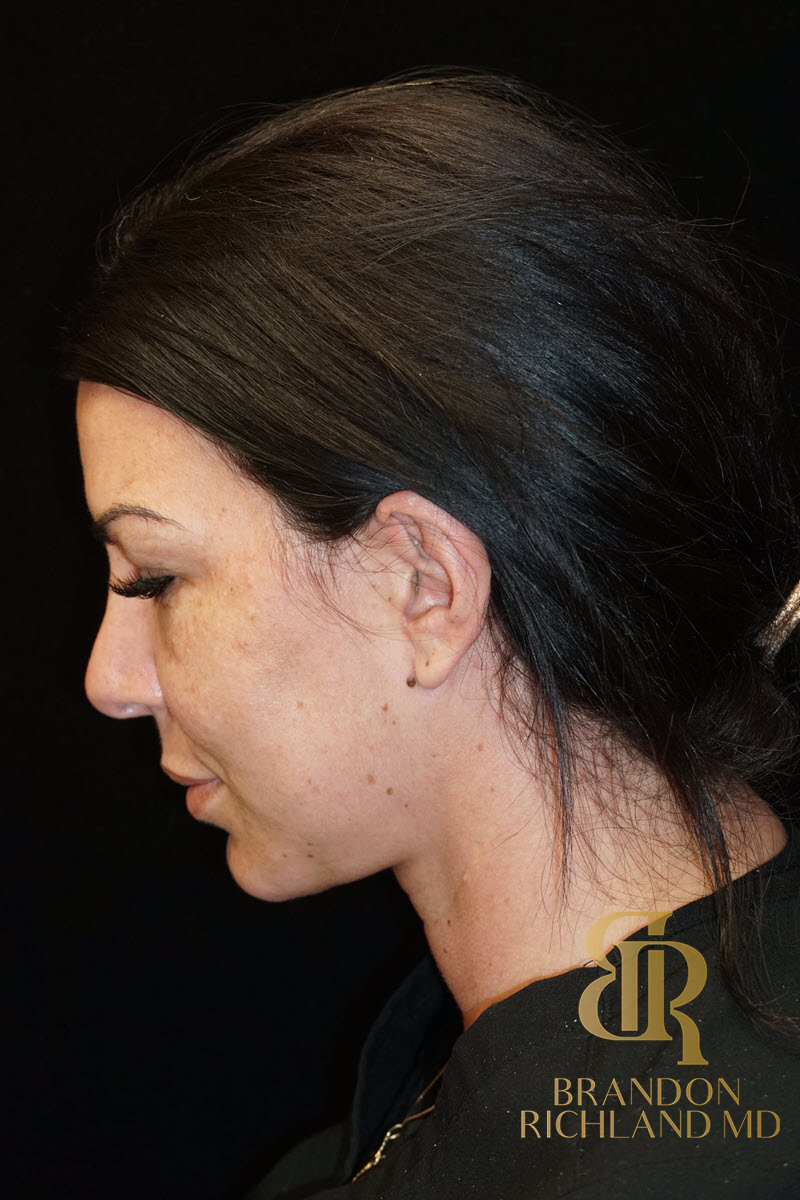 Chin Liposuction Before & After Image