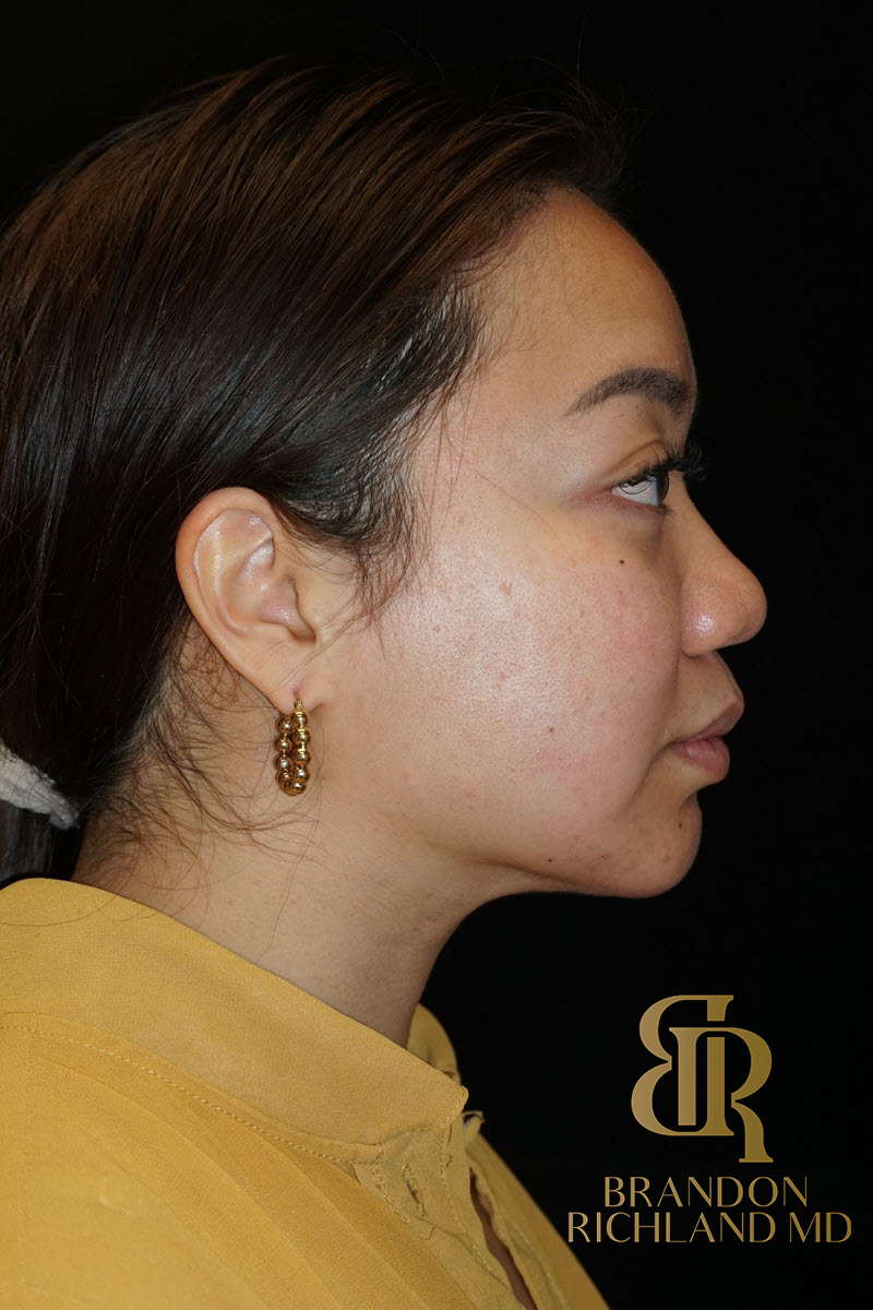 Chin Liposuction Before & After Image