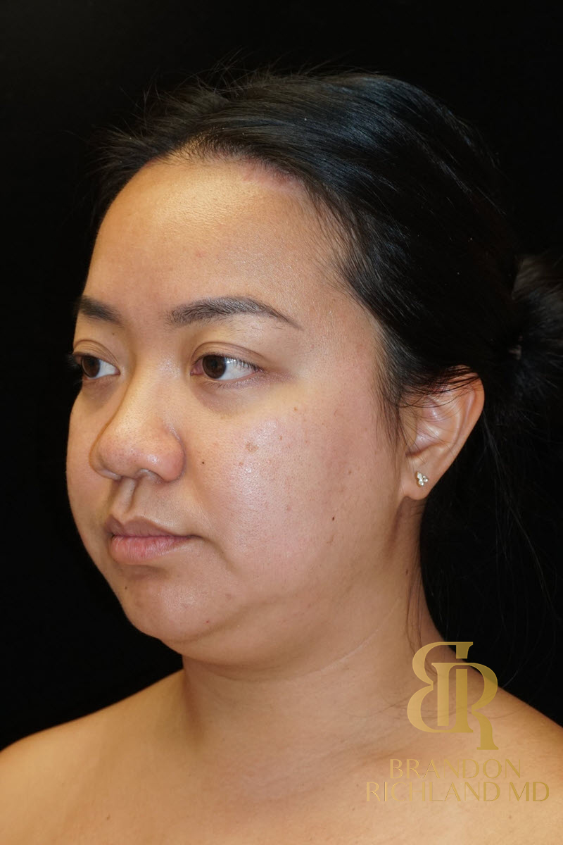 Chin Liposuction Before & After Image