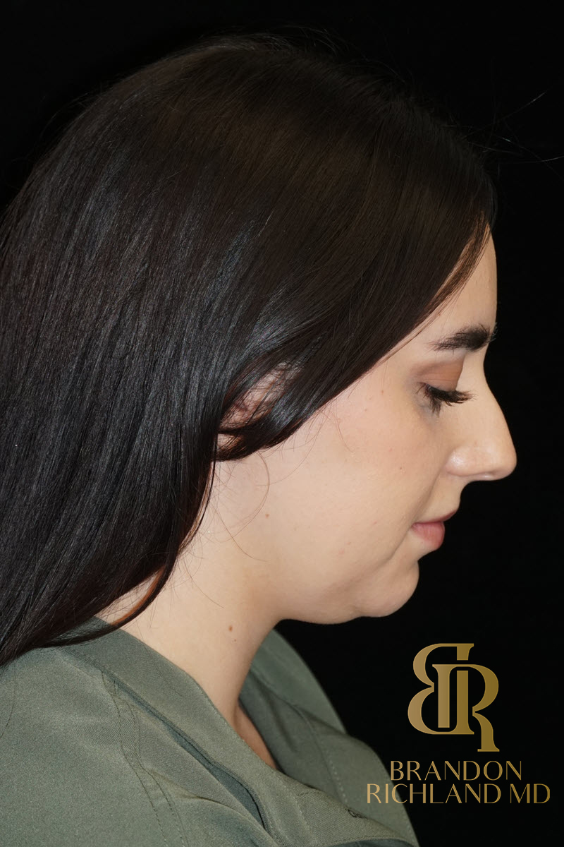 Chin Liposuction Before & After Image