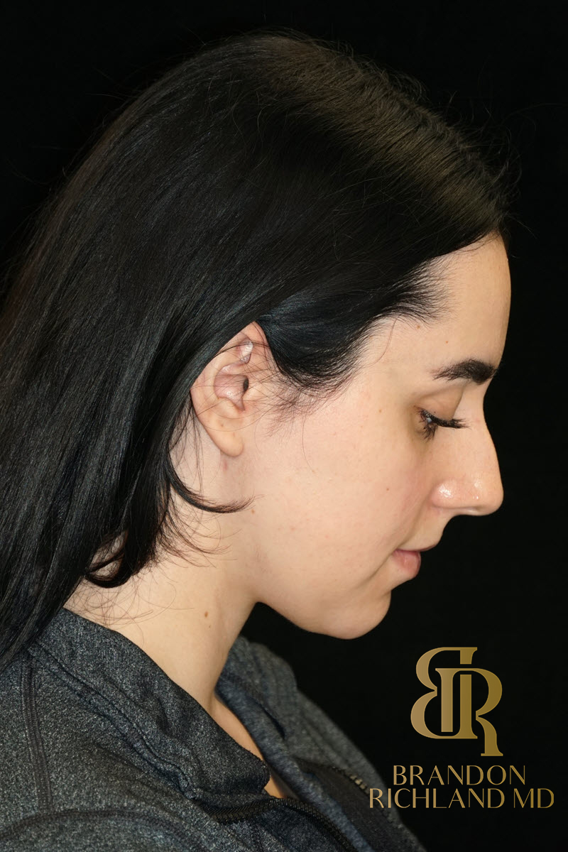 Chin Liposuction Before & After Image