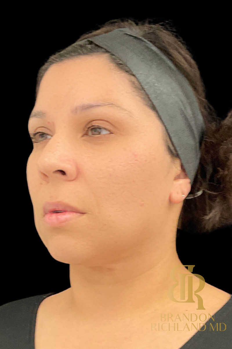Chin Liposuction Before & After Image