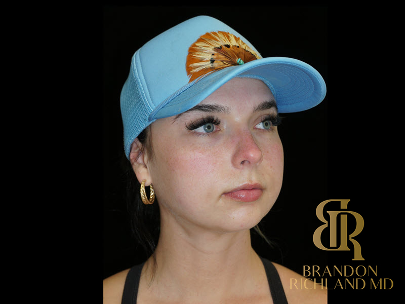 Chin Liposuction Before & After Image