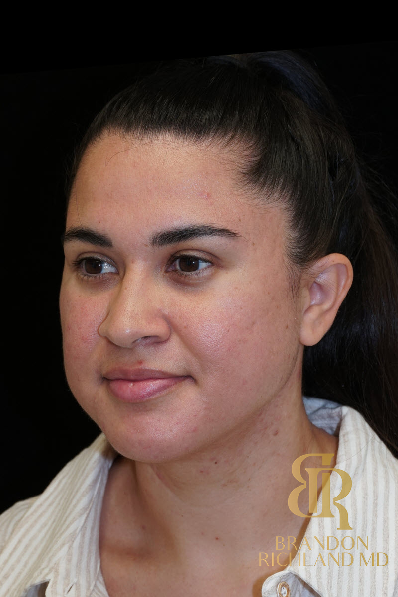 Chin Liposuction Before & After Image