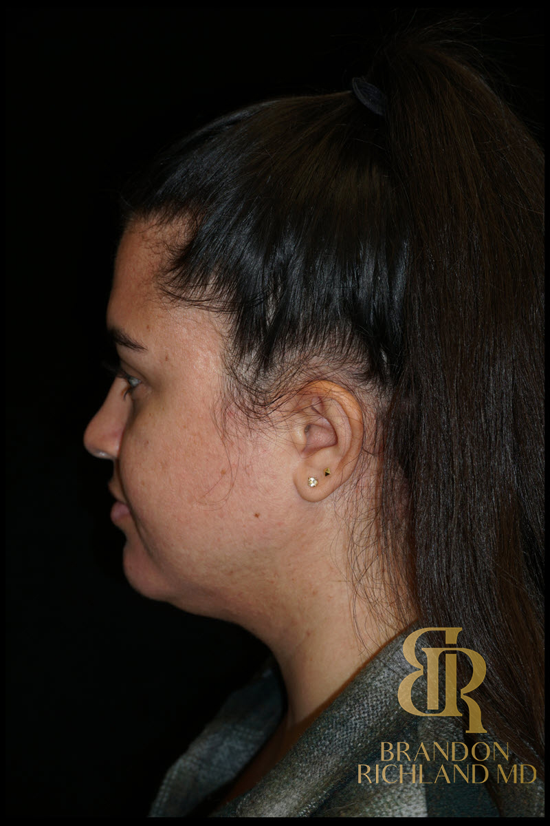 Chin Liposuction Before & After Image
