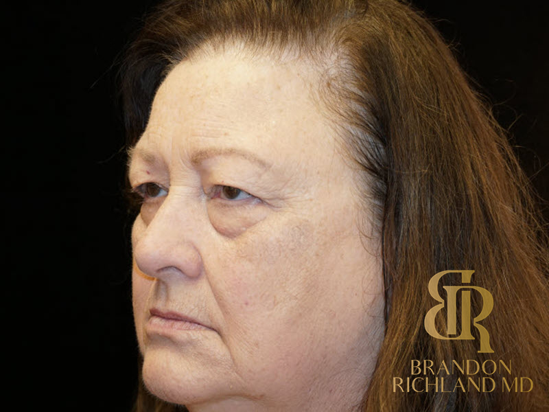 Eyelid Lift Before & After Image