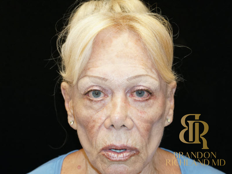 Eyelid Lift Before & After Image