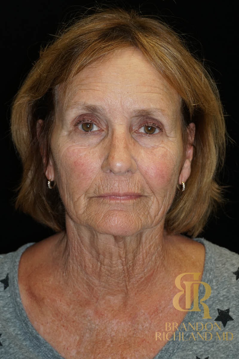 Eyelid Lift Before & After Image