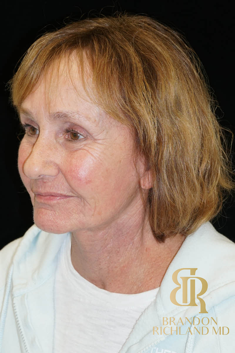 Eyelid Lift Before & After Image
