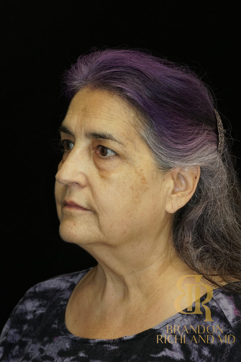 Eyelid Lift Before & After Image
