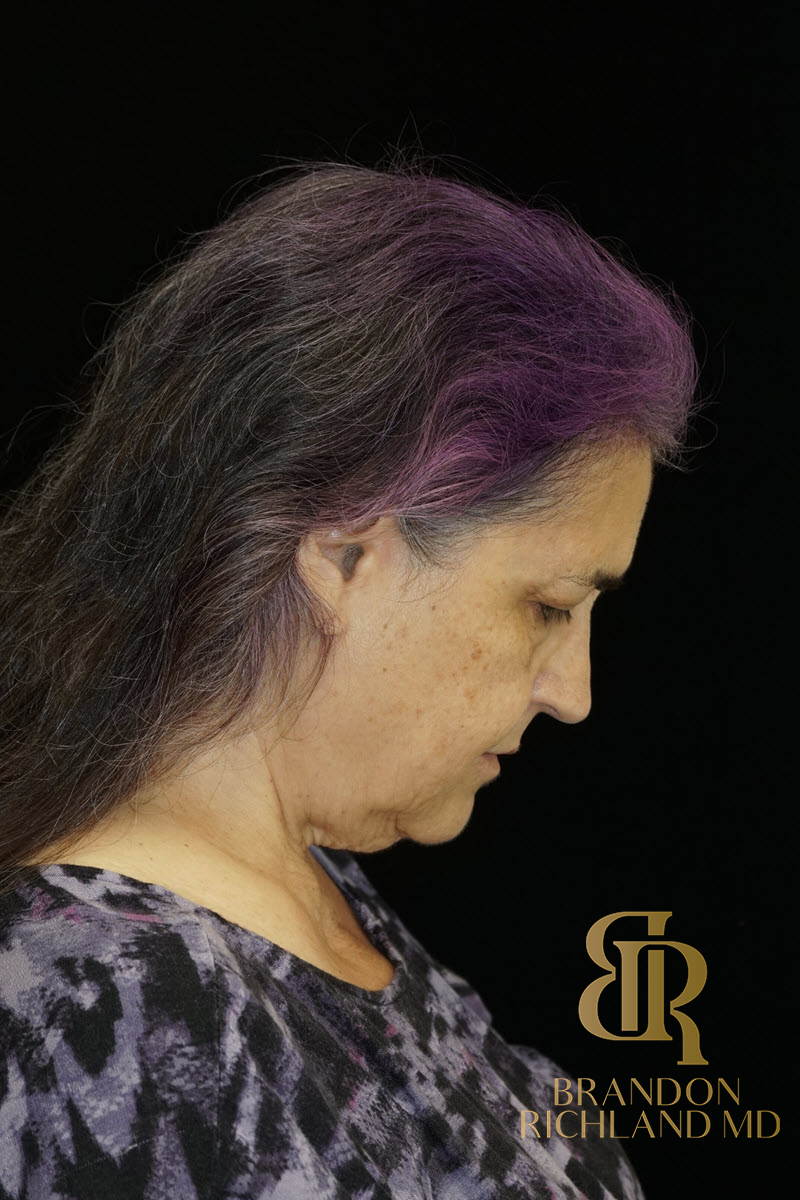 Eyelid Lift Before & After Image