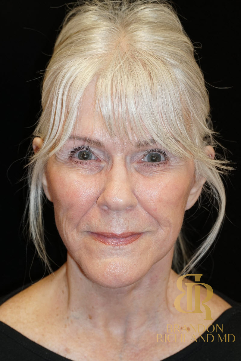 Facelift & Neck Lift Before & After Image