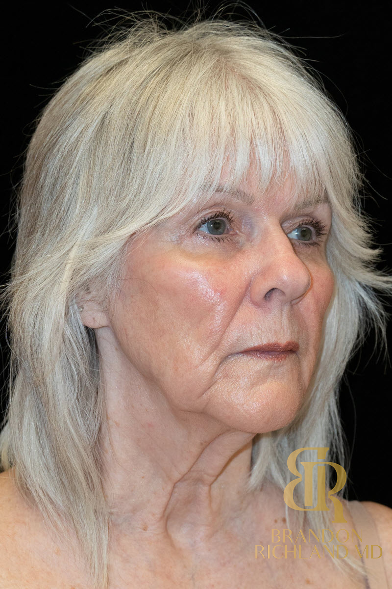 Facelift & Neck Lift Before & After Image