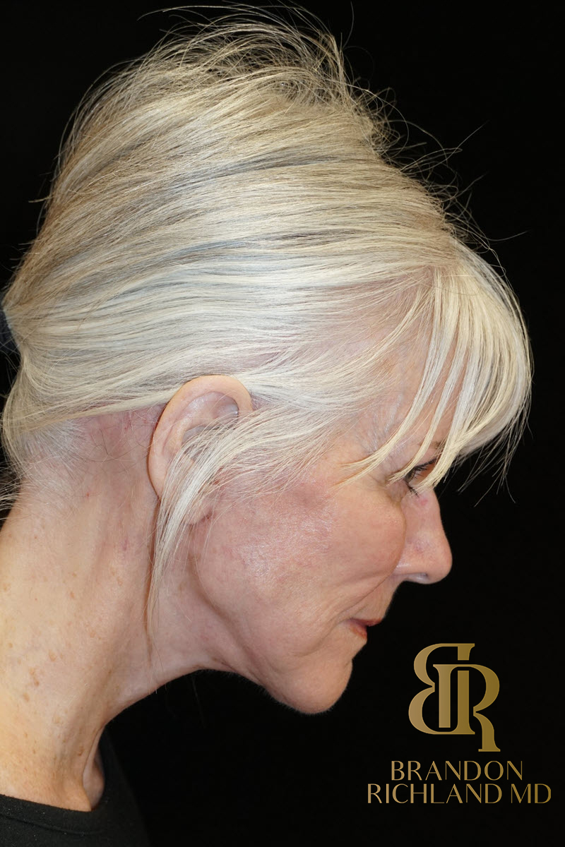 Facelift & Neck Lift Before & After Image