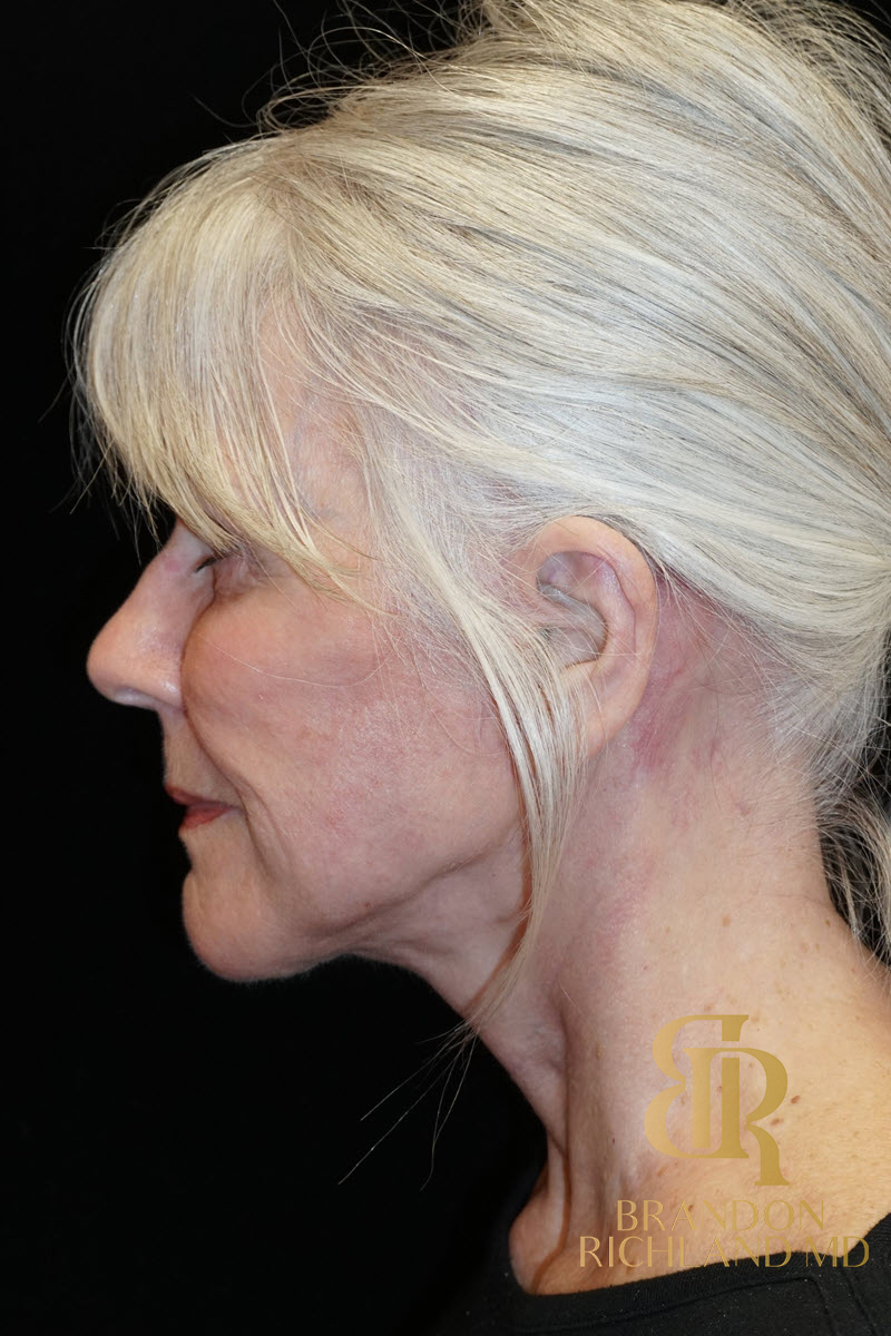 Facelift & Neck Lift Before & After Image