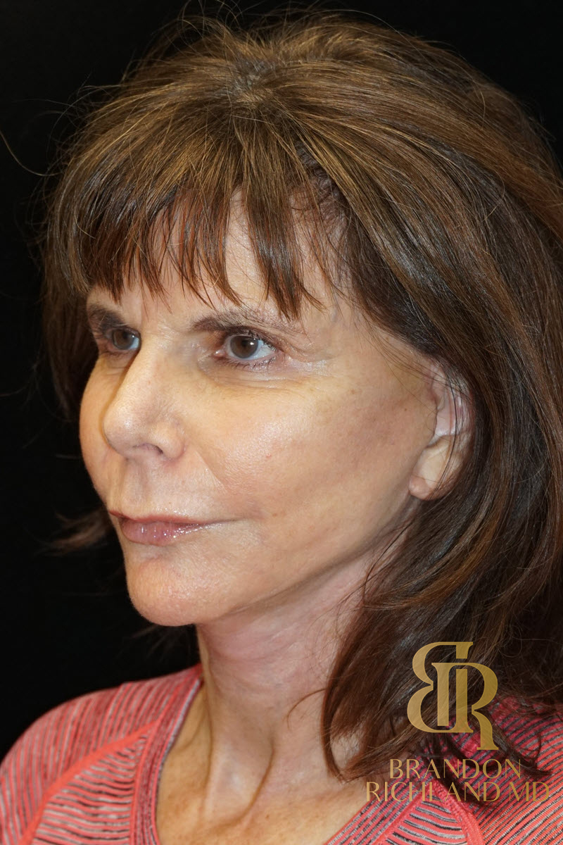 Facelift & Neck Lift Before & After Image