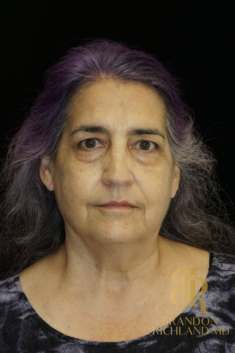 Facial Fat Transfer Before & After Image