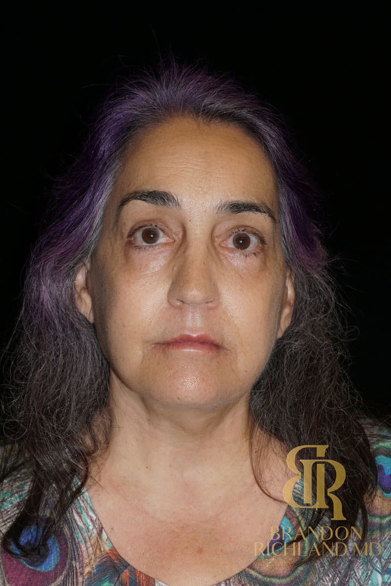 Facial Fat Transfer Before & After Image