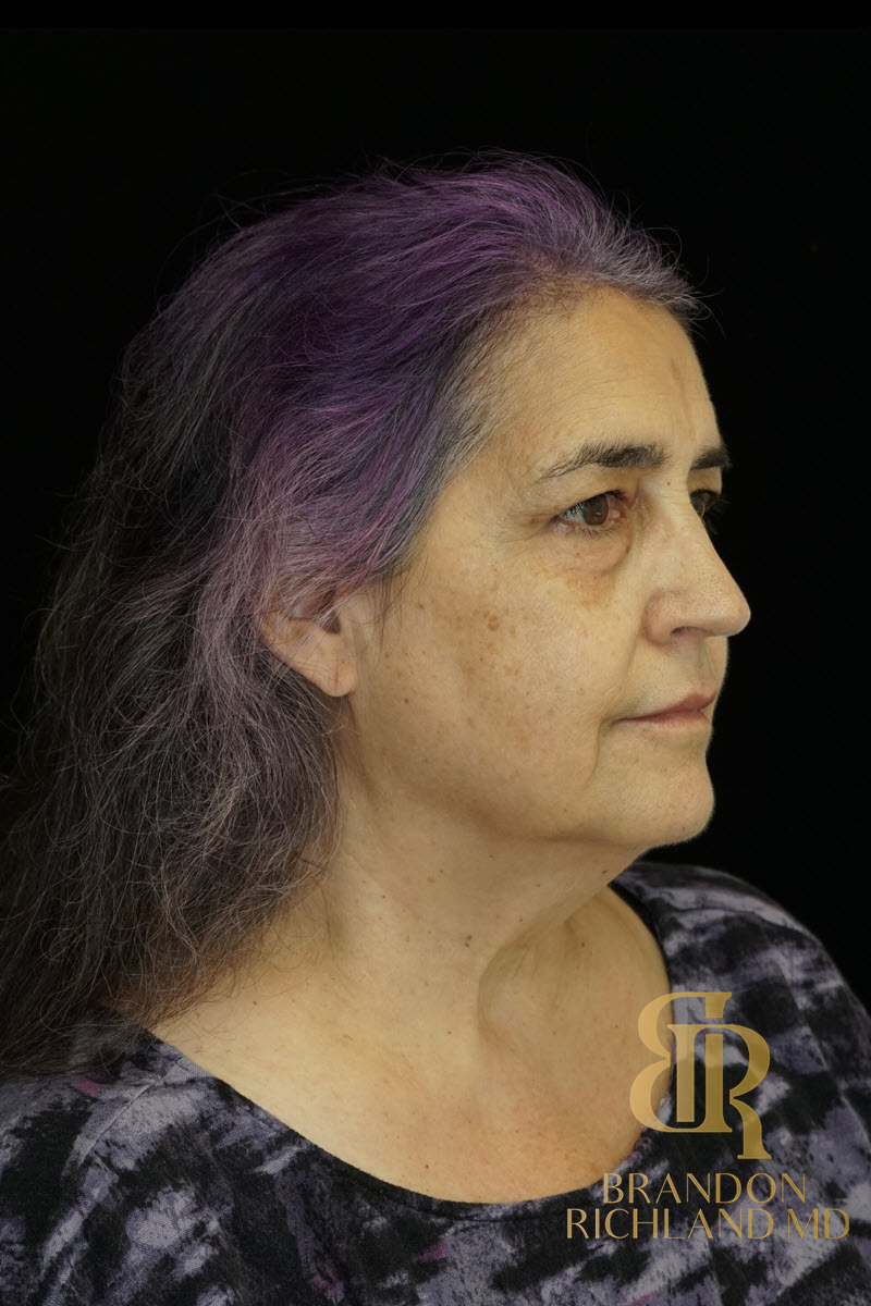 Facial Fat Transfer Before & After Image