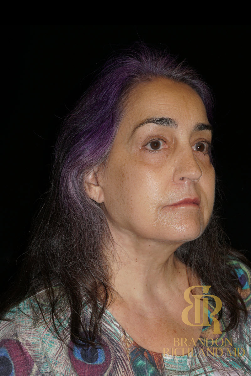Facial Fat Transfer Before & After Image