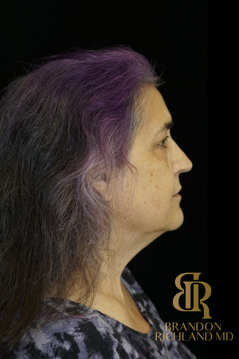 Facial Fat Transfer Before & After Image