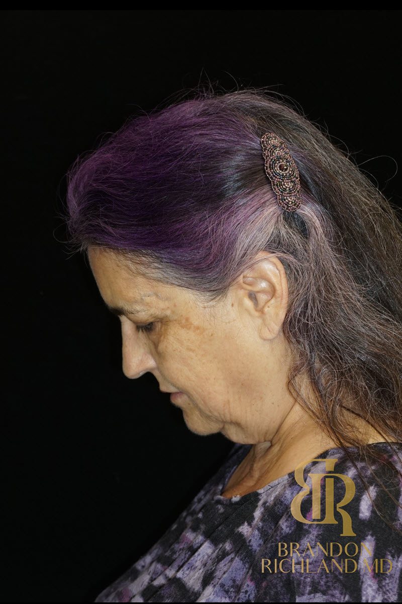 Facial Fat Transfer Before & After Image