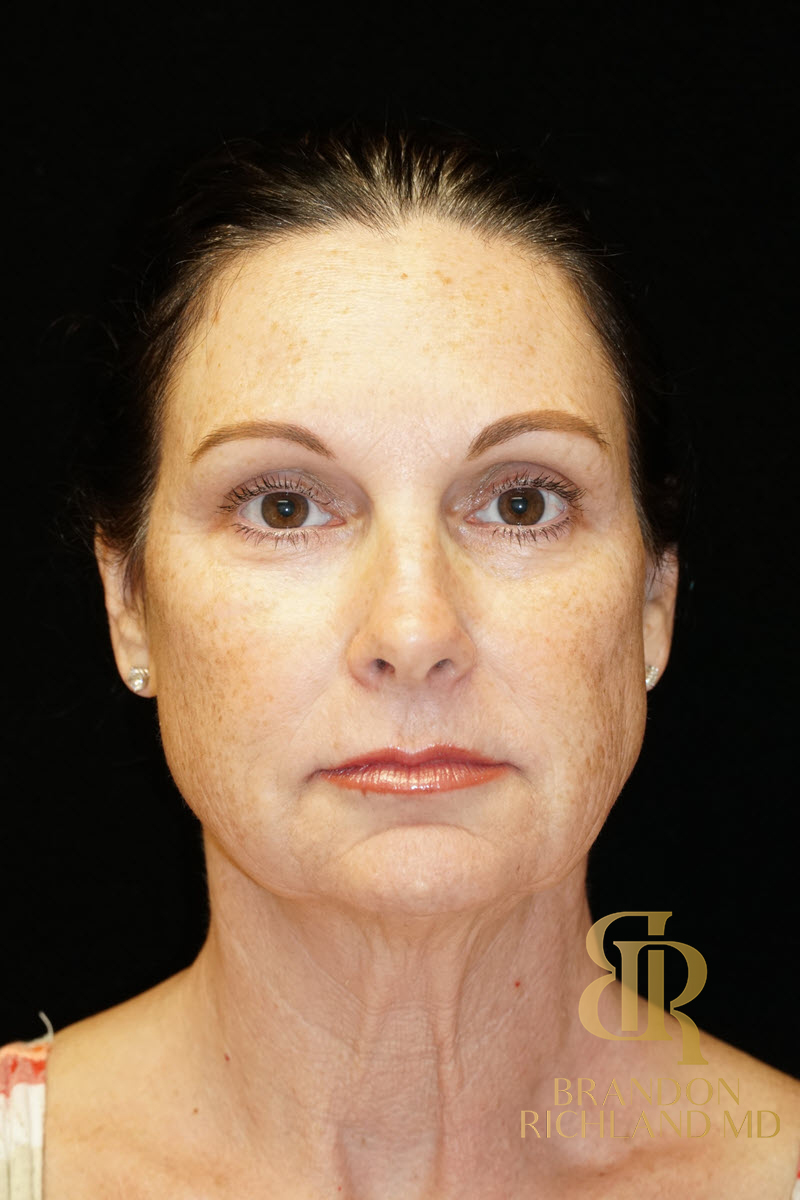 Facial Fat Transfer Before & After Image