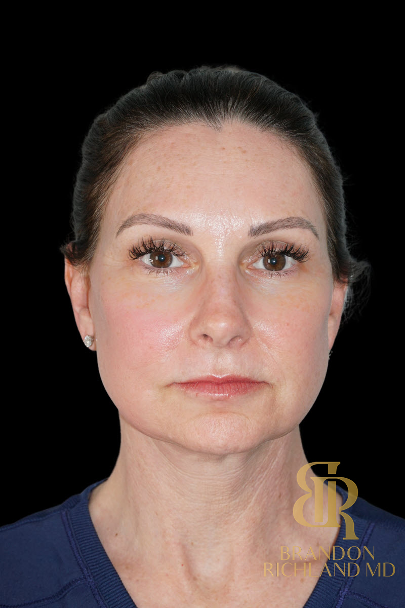 Facial Fat Transfer Before & After Image