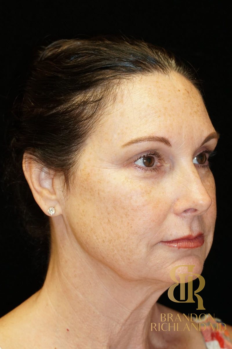 Facial Fat Transfer Before & After Image
