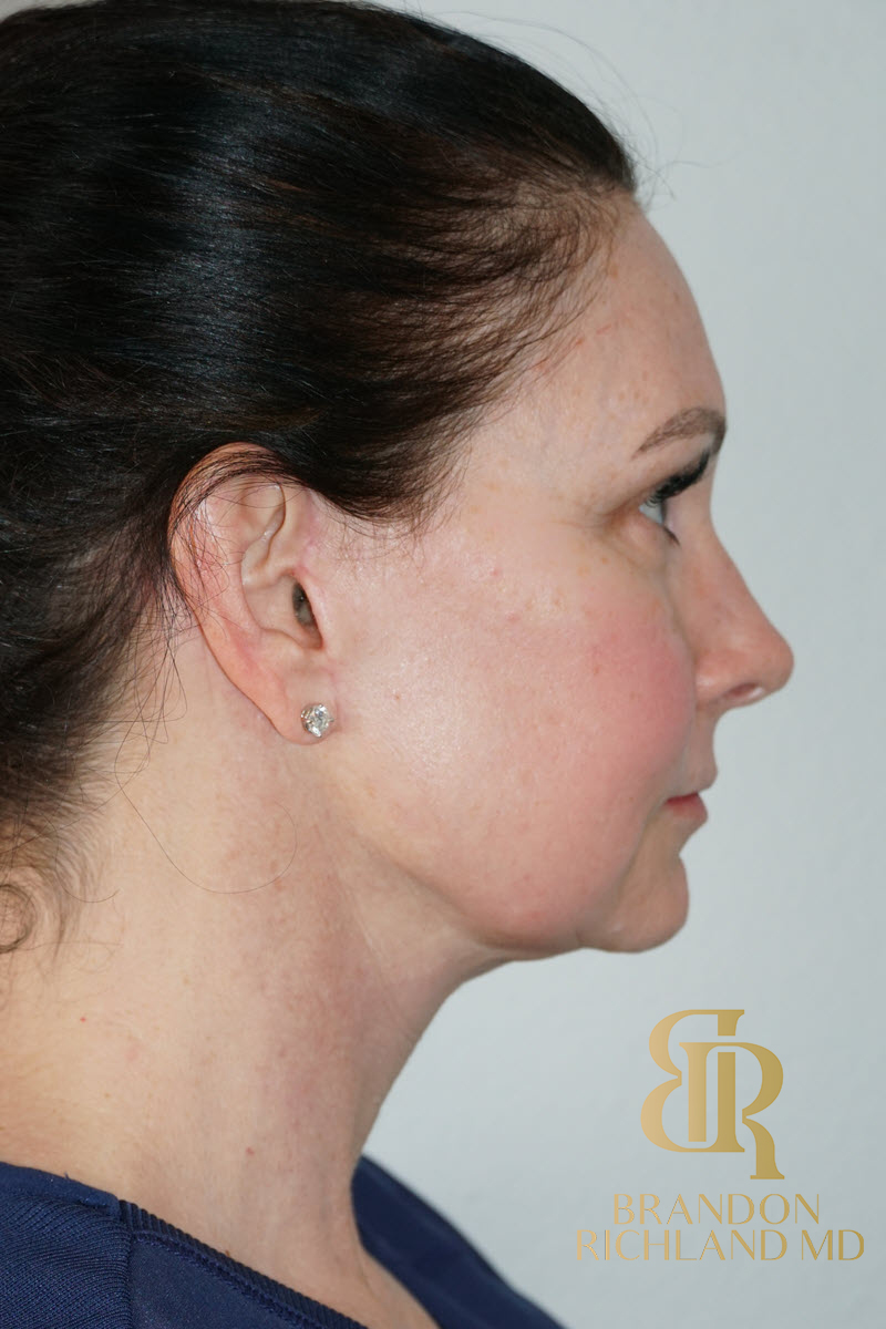 Facial Fat Transfer Before & After Image