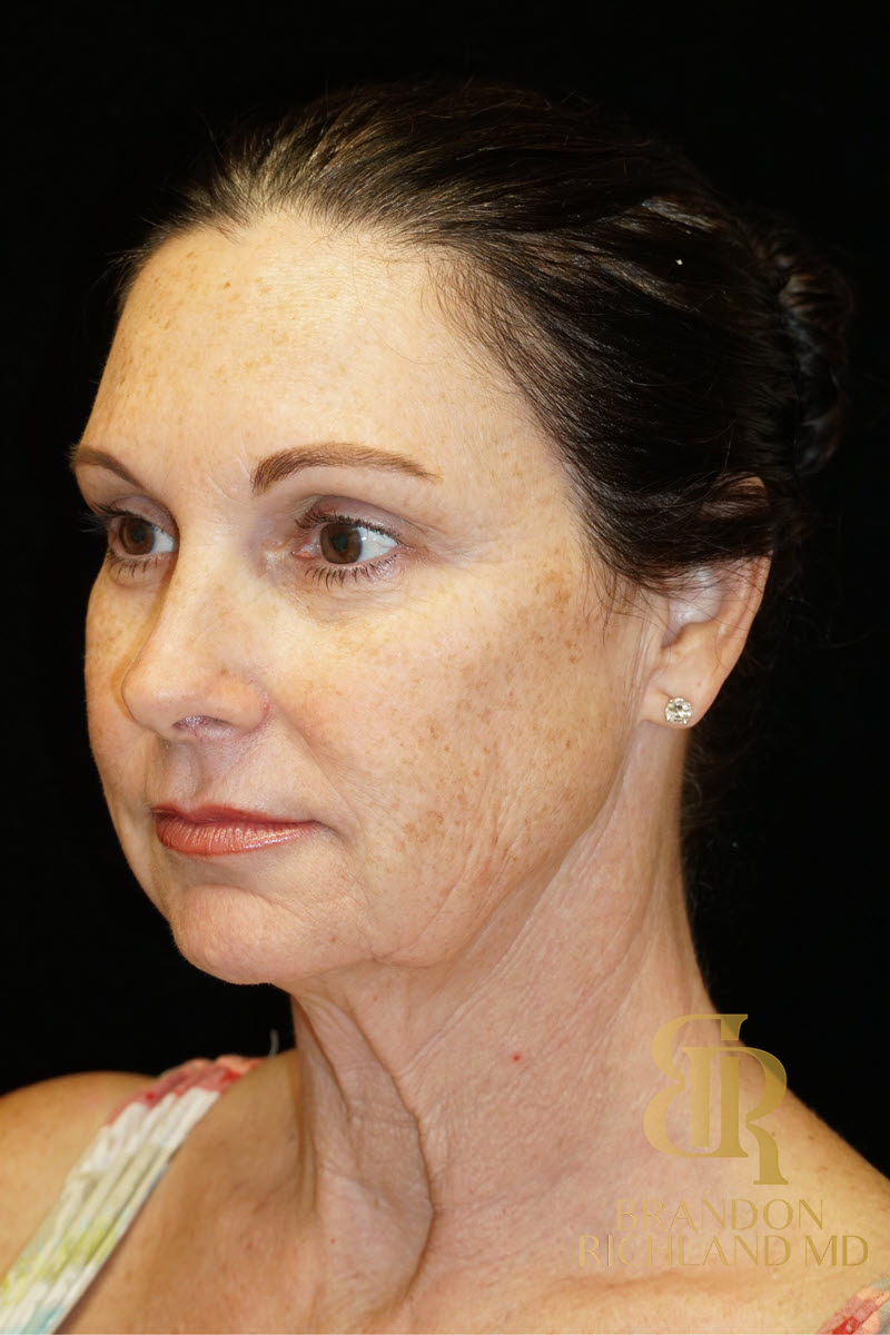 Facial Fat Transfer Before & After Image