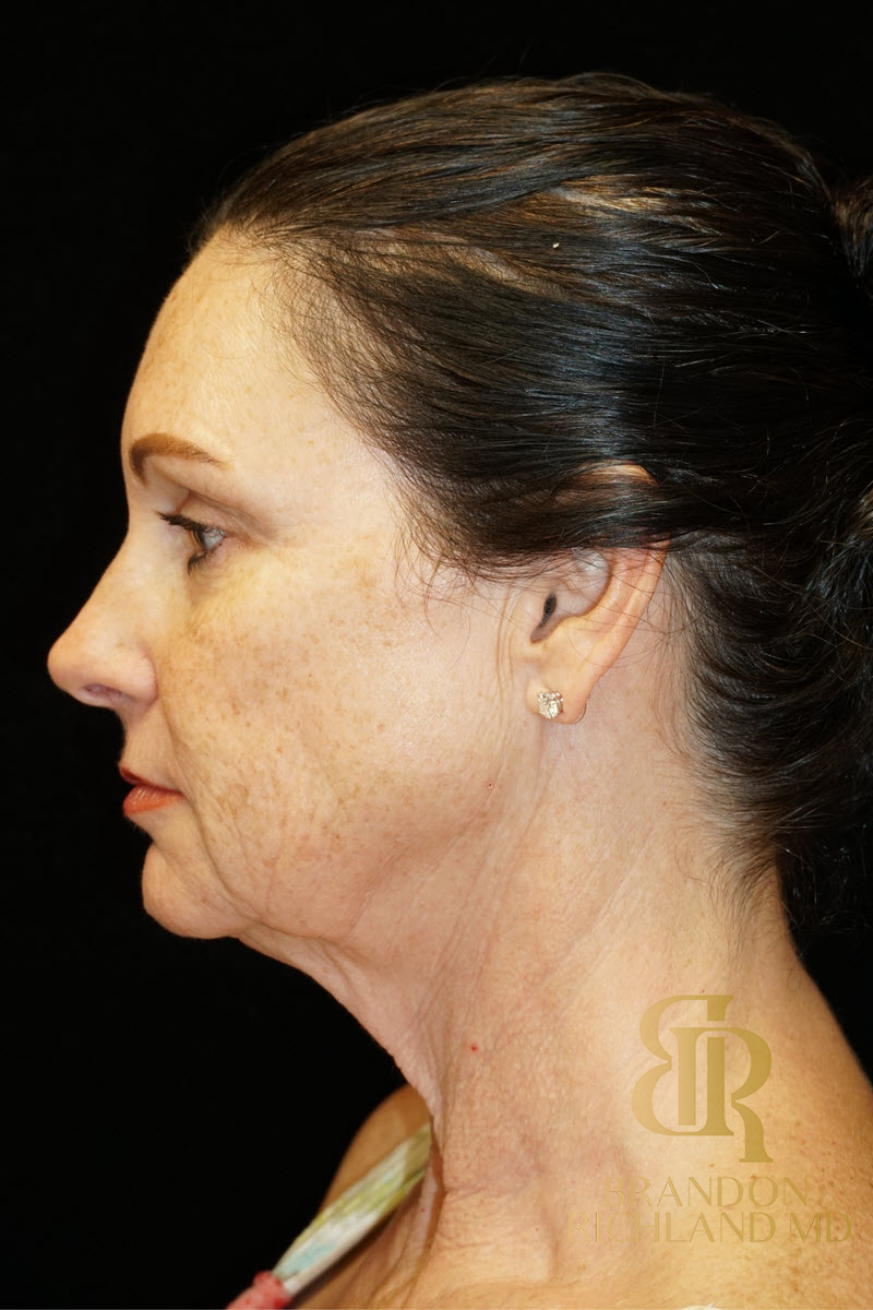 Facial Fat Transfer Before & After Image