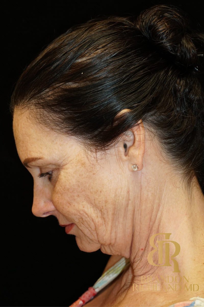 Facial Fat Transfer Before & After Image