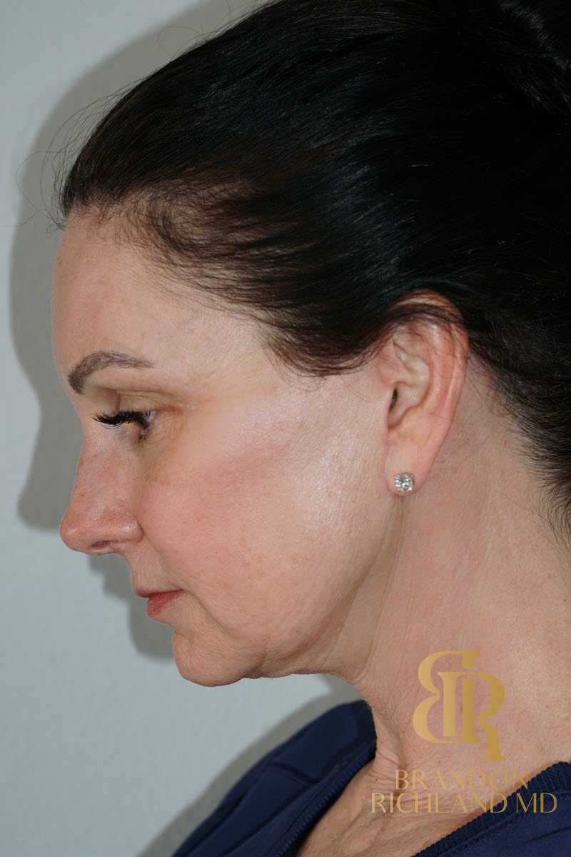 Facial Fat Transfer Before & After Image