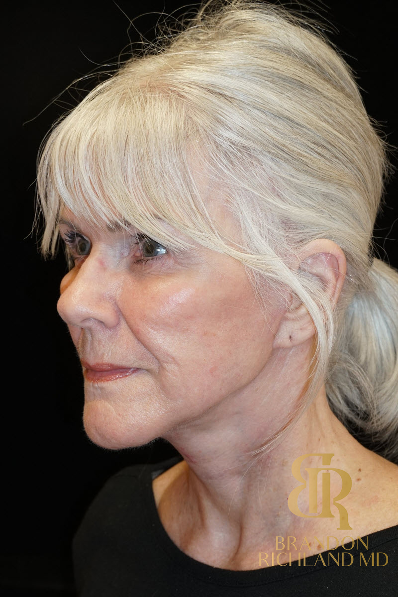 Facial Fat Transfer Before & After Image