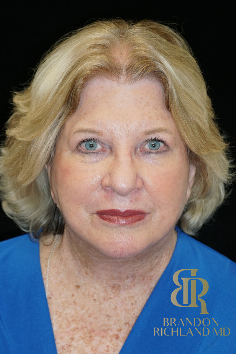 Facial Fat Transfer Before & After Image