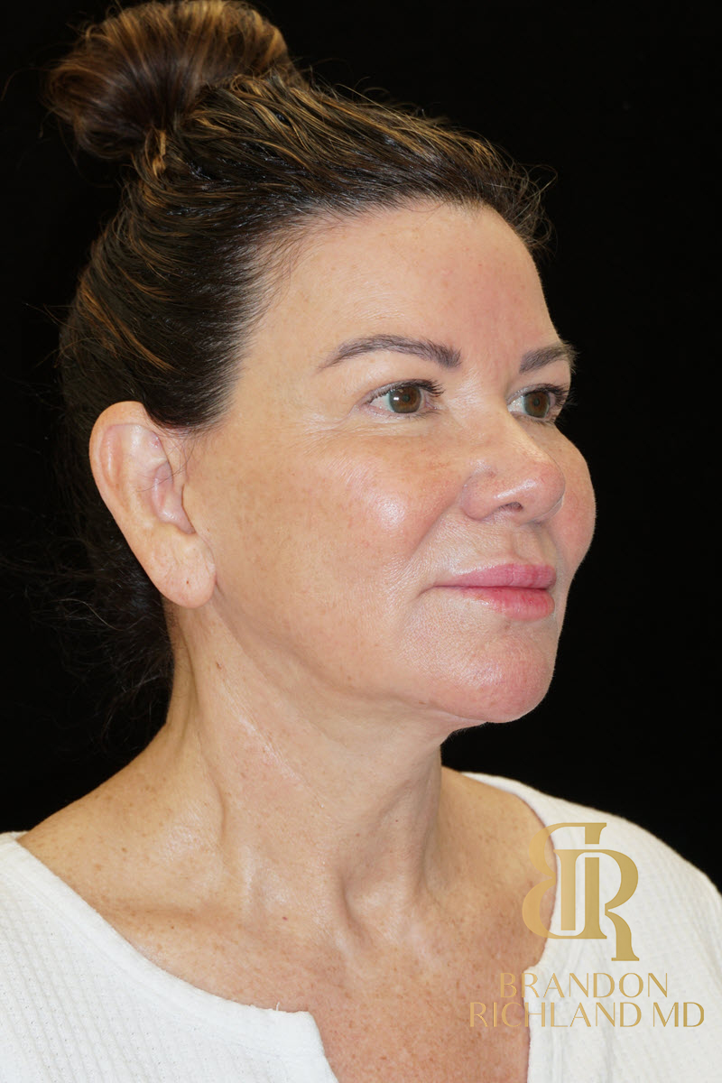 Facial Fat Transfer Before & After Image