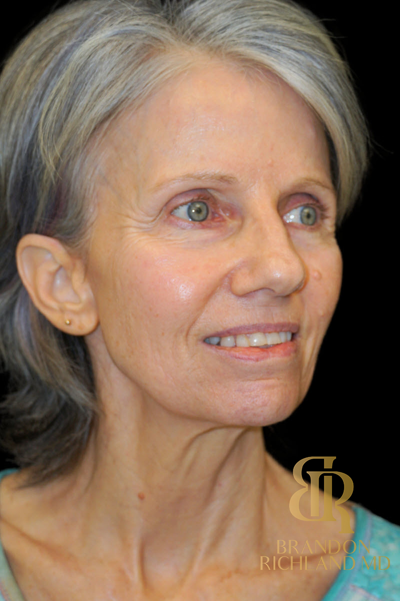 Facial Fat Transfer Before & After Image