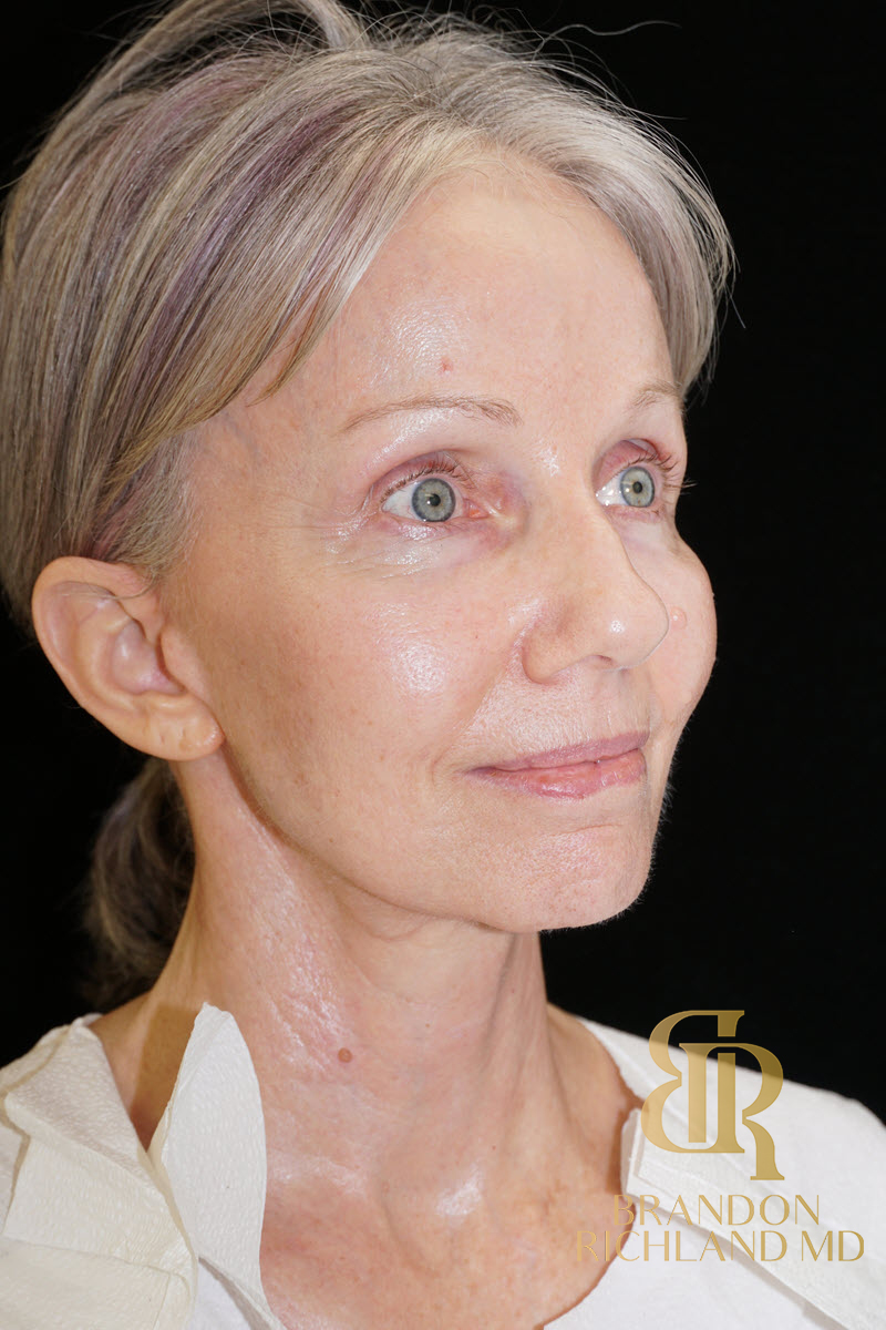 Facial Fat Transfer Before & After Image
