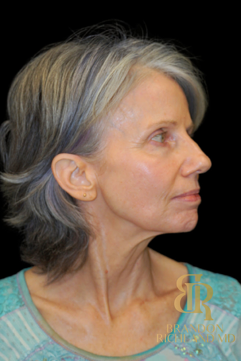 Facial Fat Transfer Before & After Image