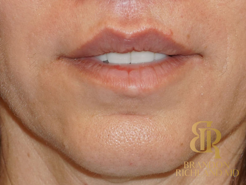 Lip Lift Before & After Image