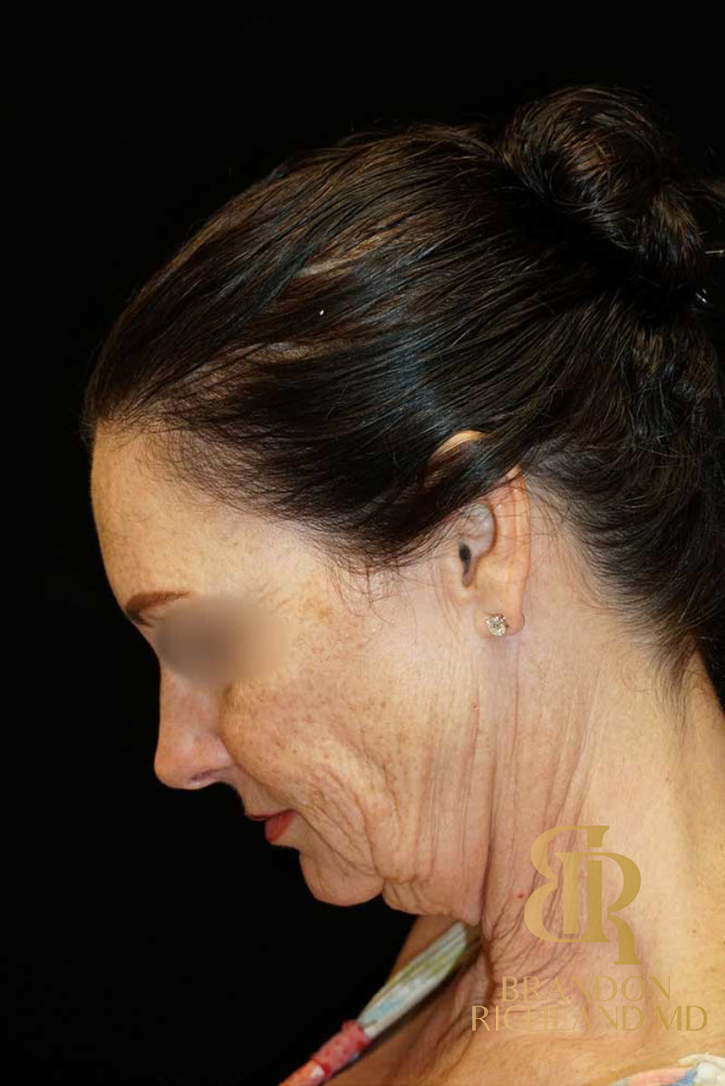 Neck Lift Before & After Image