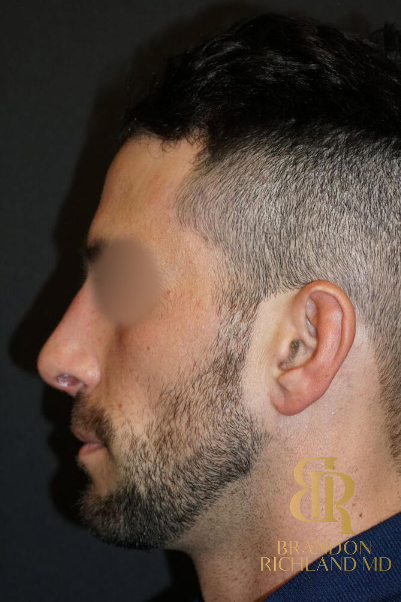 Rhinoplasty Before & After Image